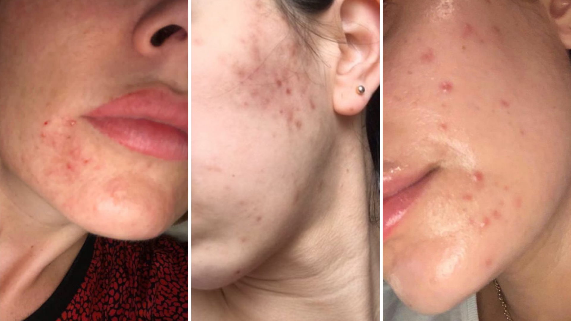 What is cystic acne?